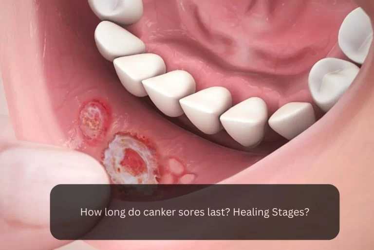 How long do canker sores last? Healing Stages