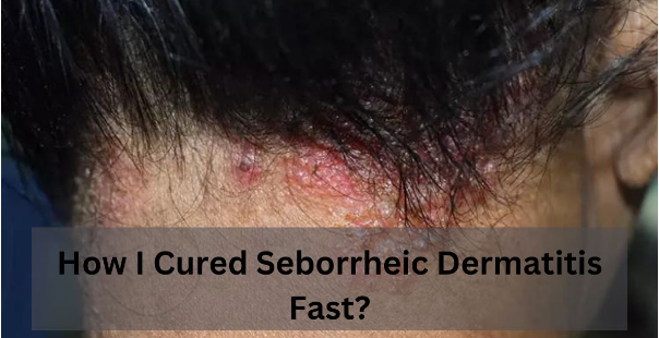 How I Cured Seborrheic Dermatitis Fast?