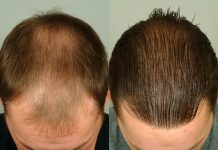 Hair Confidence Starts Here – Simple Fixes for Hair Thinning